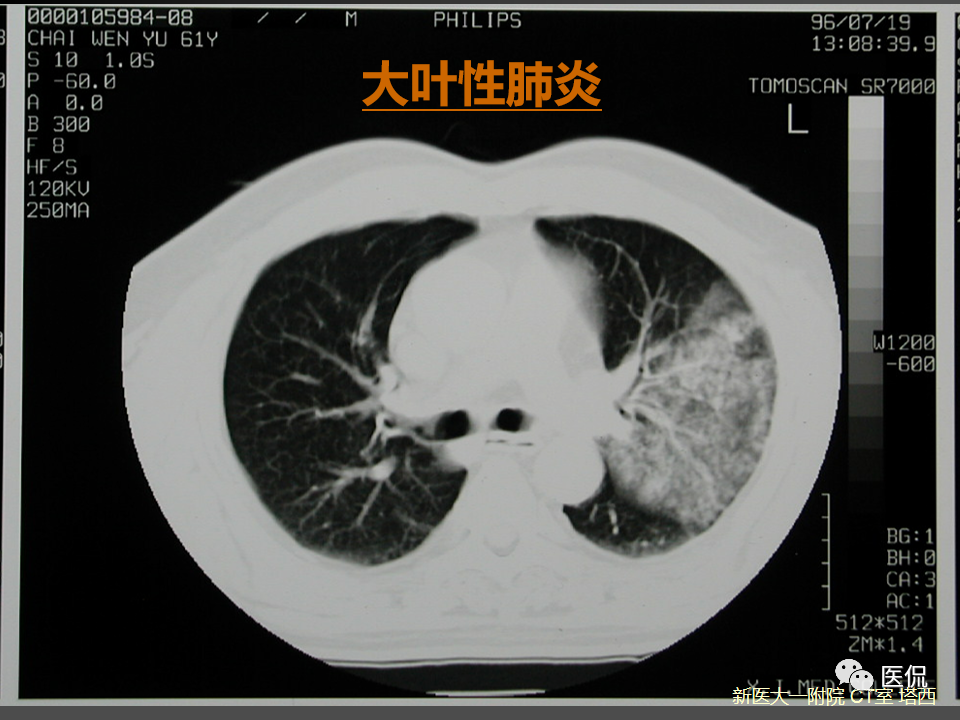 影像PPT - 【PPT】呼吸系统常见疾病影像诊断-41