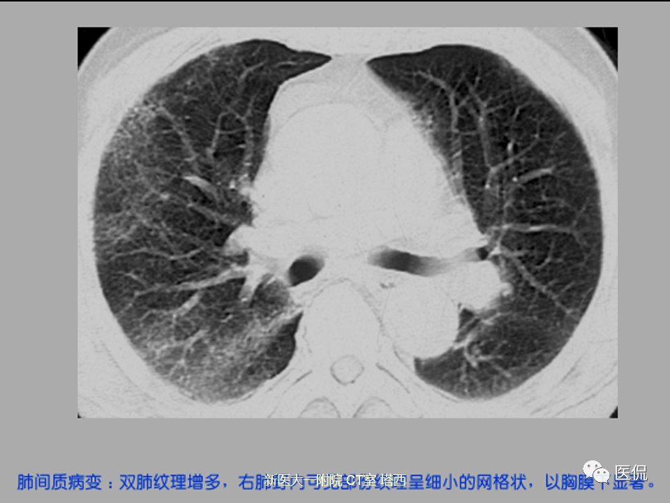 影像PPT - 【PPT】呼吸系统常见疾病影像诊断-45