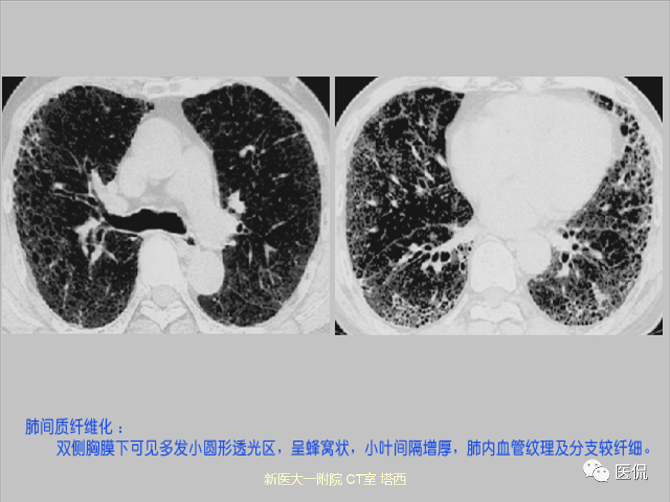影像PPT - 【PPT】呼吸系统常见疾病影像诊断-46