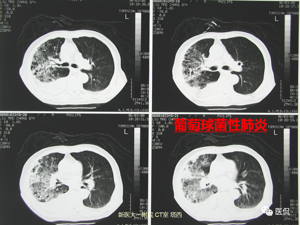 影像PPT - 【PPT】呼吸系统常见疾病影像诊断-50
