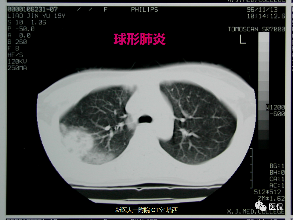影像PPT - 【PPT】呼吸系统常见疾病影像诊断-51