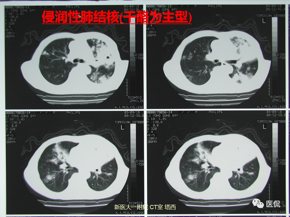 影像PPT - 【PPT】呼吸系统常见疾病影像诊断-69