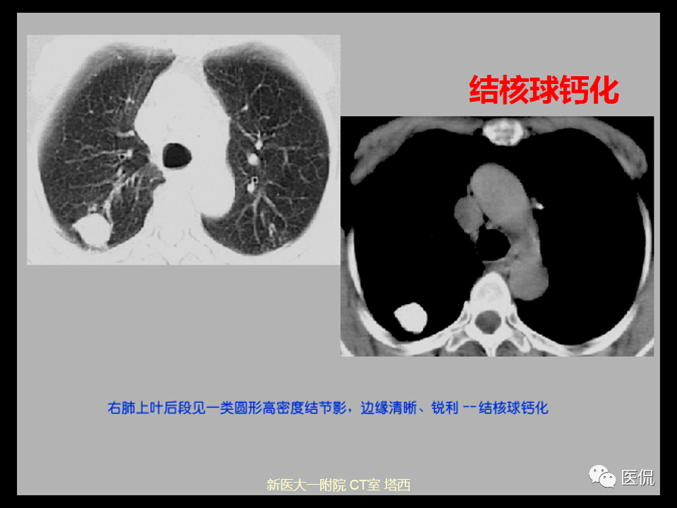 影像PPT - 【PPT】呼吸系统常见疾病影像诊断-72