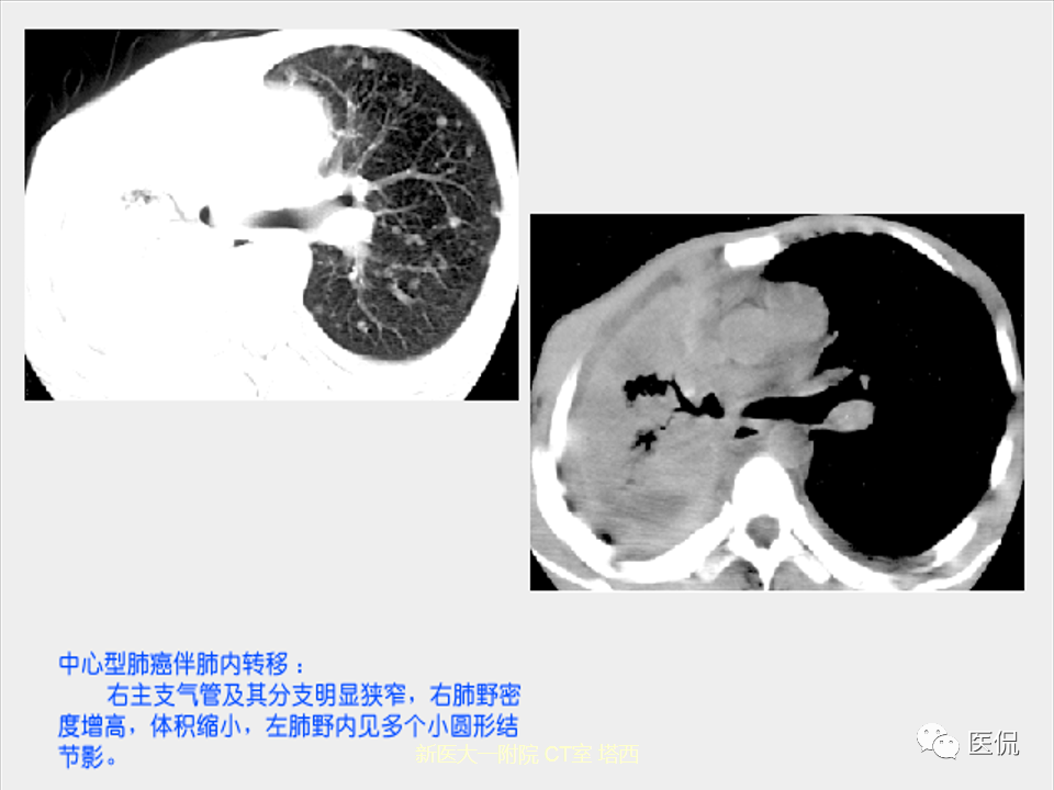影像PPT - 【PPT】呼吸系统常见疾病影像诊断-79