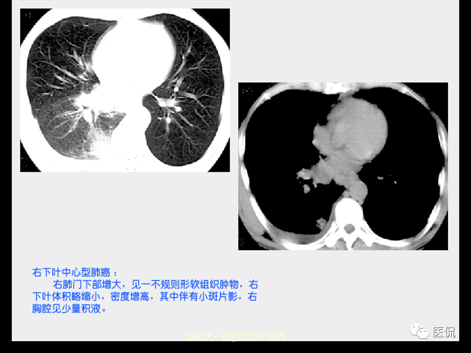 影像PPT - 【PPT】呼吸系统常见疾病影像诊断-80
