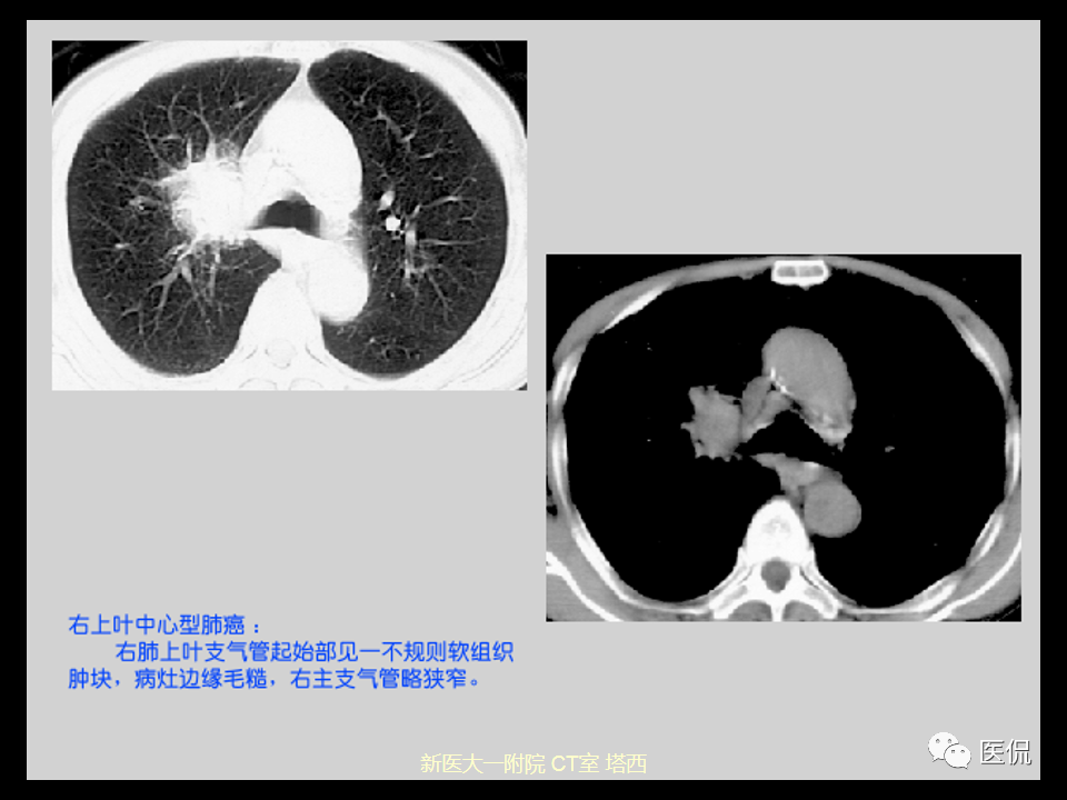 影像PPT - 【PPT】呼吸系统常见疾病影像诊断-81