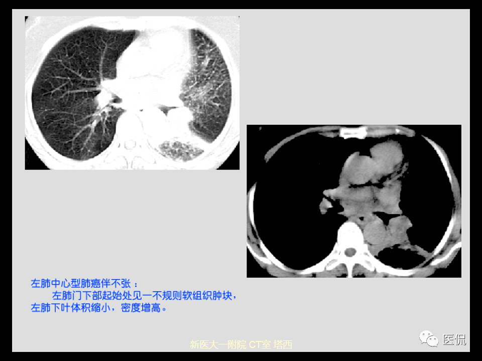 影像PPT - 【PPT】呼吸系统常见疾病影像诊断-82