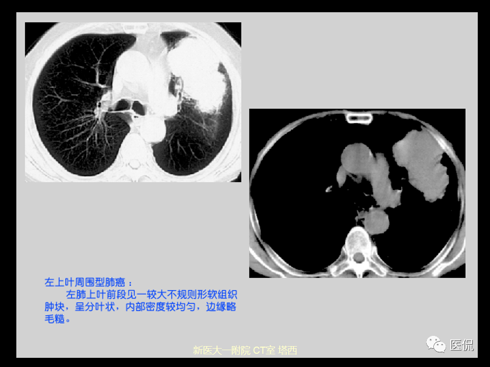 影像PPT - 【PPT】呼吸系统常见疾病影像诊断-85