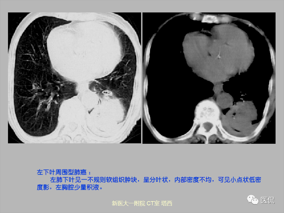 影像PPT - 【PPT】呼吸系统常见疾病影像诊断-86