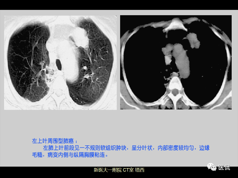 影像PPT - 【PPT】呼吸系统常见疾病影像诊断-87