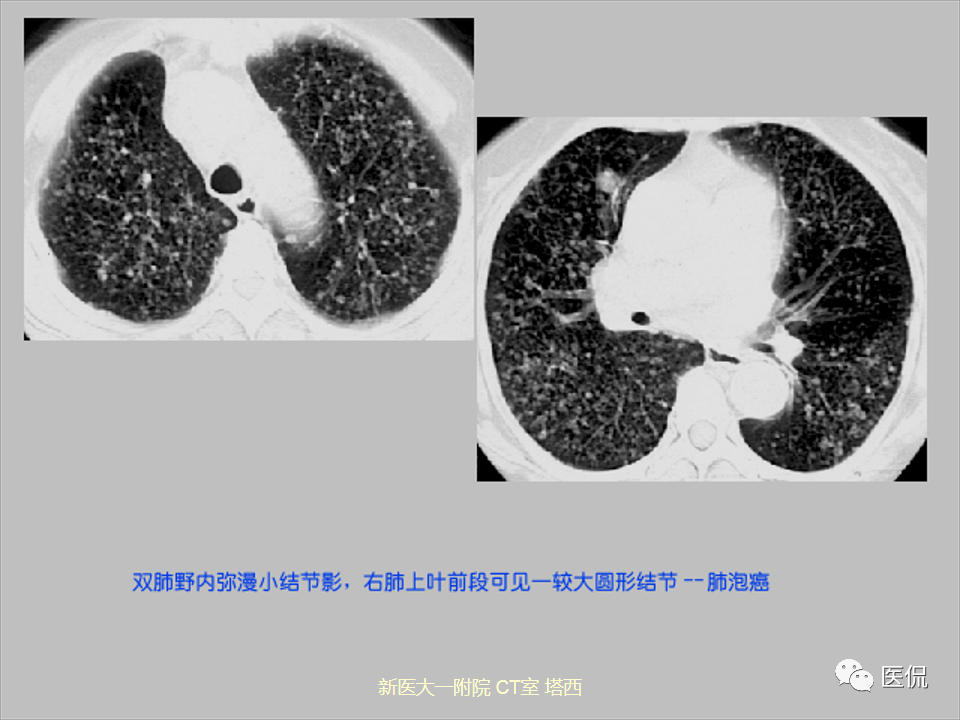 影像PPT - 【PPT】呼吸系统常见疾病影像诊断-91