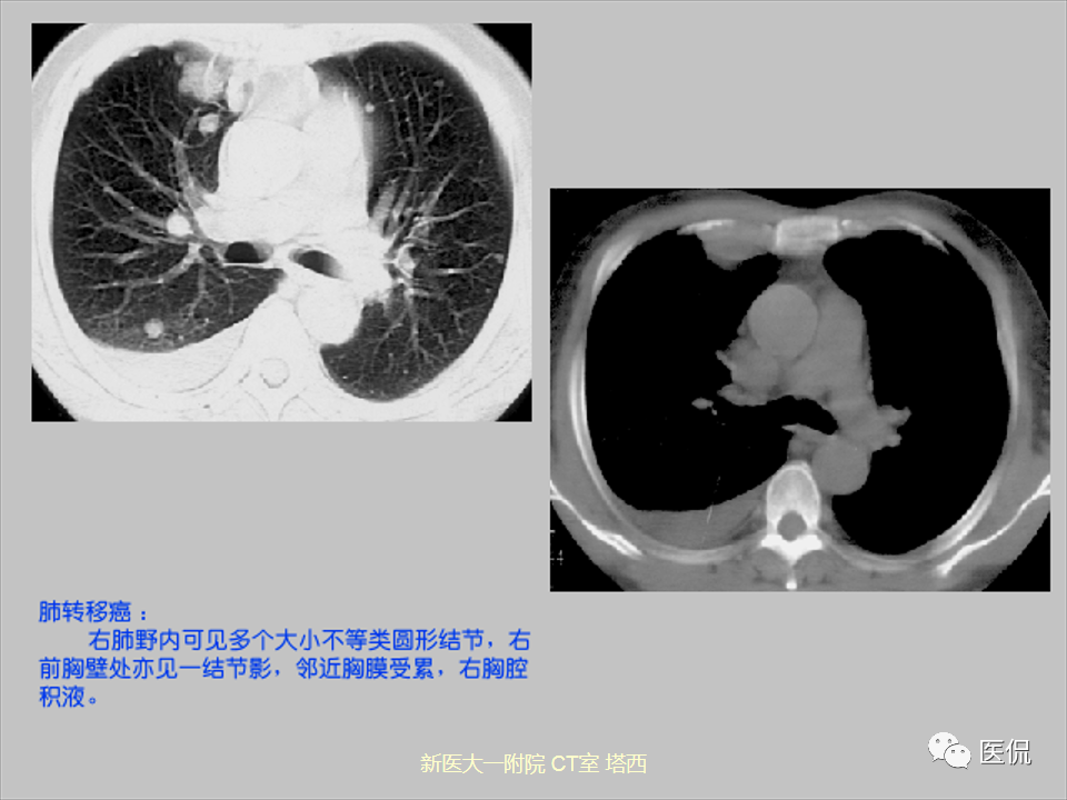 影像PPT - 【PPT】呼吸系统常见疾病影像诊断-94