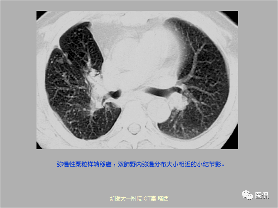影像PPT - 【PPT】呼吸系统常见疾病影像诊断-95