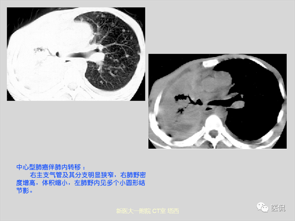影像PPT - 【PPT】呼吸系统常见疾病影像诊断-96