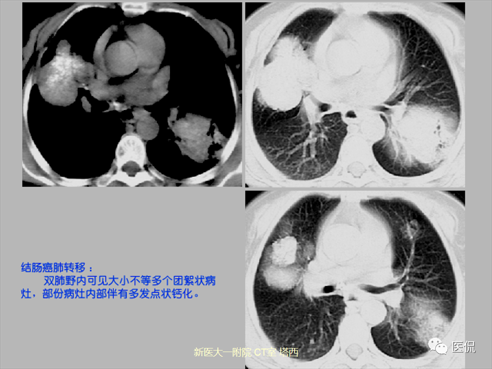 影像PPT - 【PPT】呼吸系统常见疾病影像诊断-97