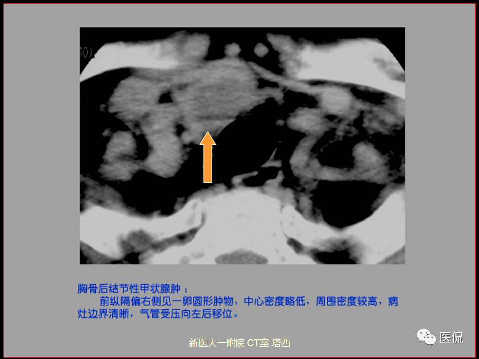 影像PPT - 【PPT】呼吸系统常见疾病影像诊断-106