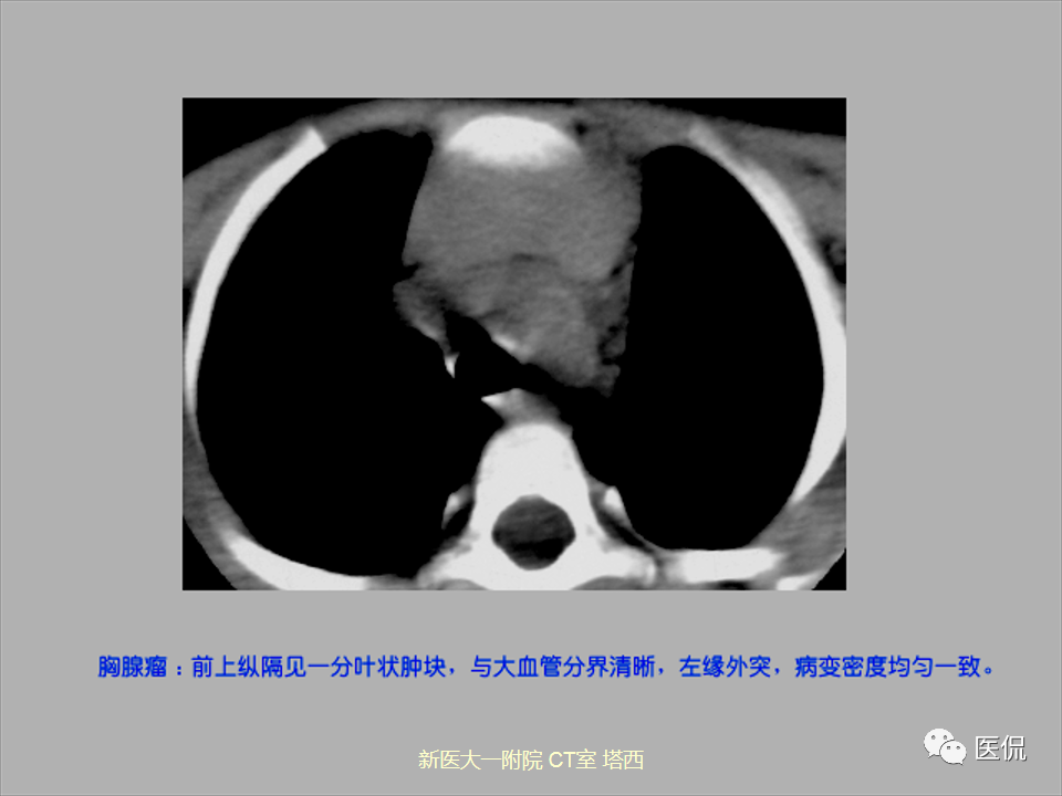 影像PPT - 【PPT】呼吸系统常见疾病影像诊断-109