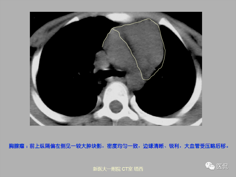 影像PPT - 【PPT】呼吸系统常见疾病影像诊断-110