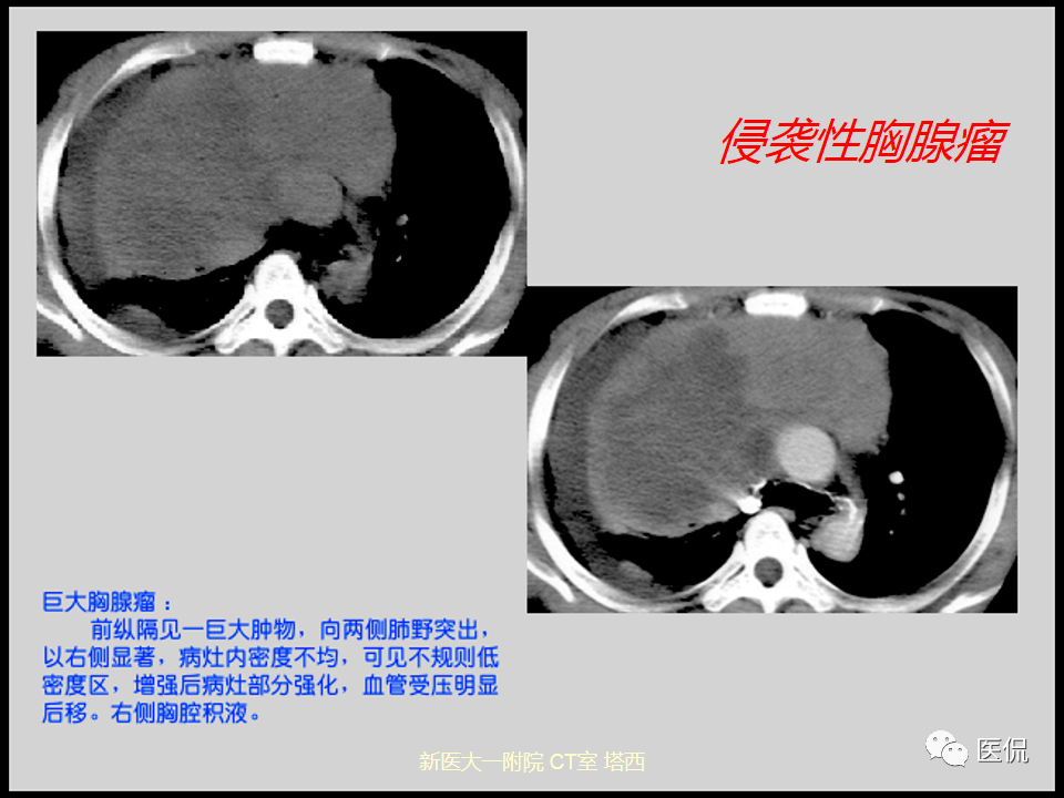 影像PPT - 【PPT】呼吸系统常见疾病影像诊断-111