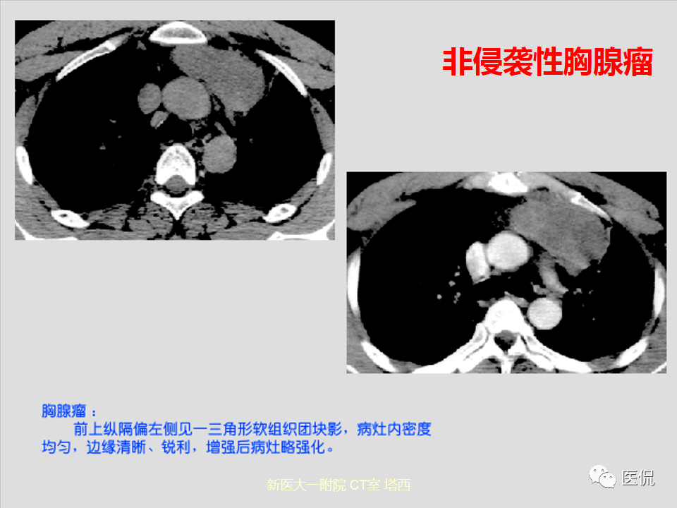 影像PPT - 【PPT】呼吸系统常见疾病影像诊断-112