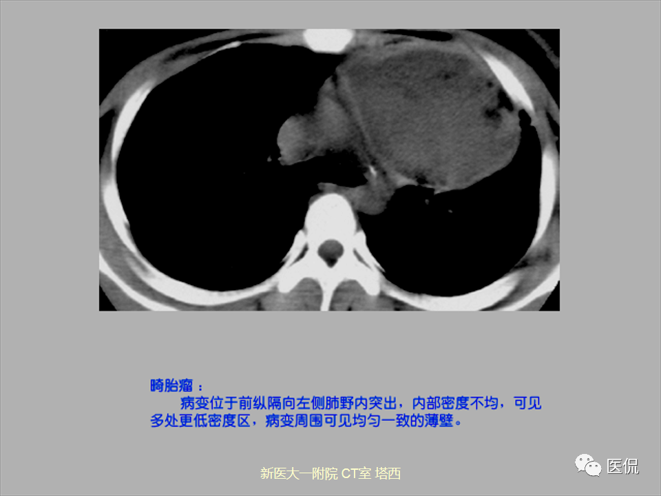 影像PPT - 【PPT】呼吸系统常见疾病影像诊断-116