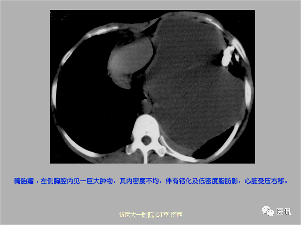 影像PPT - 【PPT】呼吸系统常见疾病影像诊断-117