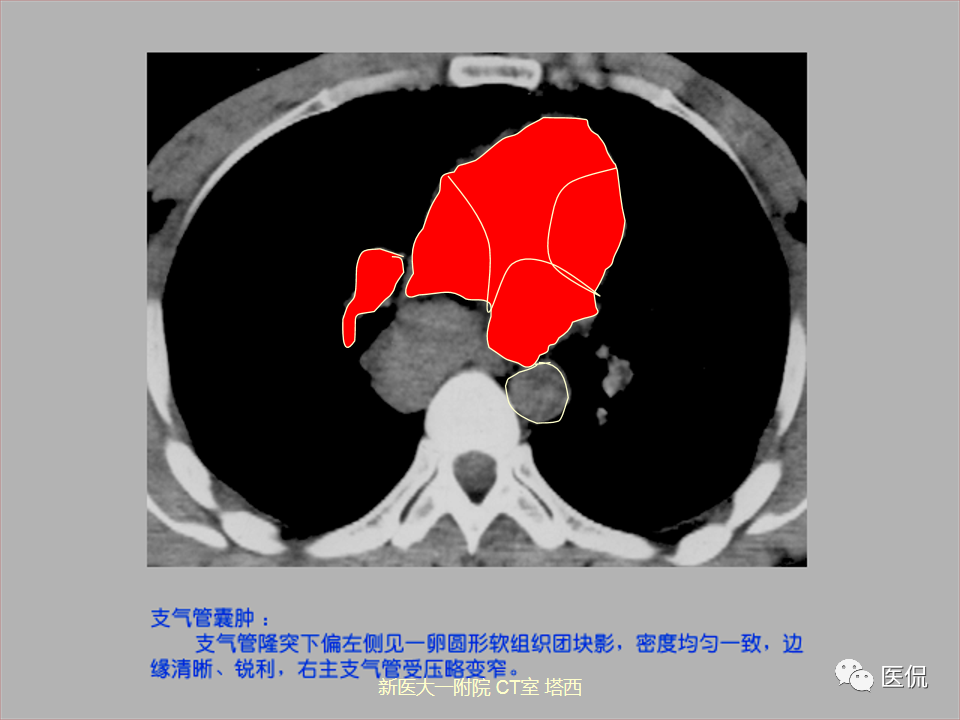 影像PPT - 【PPT】呼吸系统常见疾病影像诊断-121