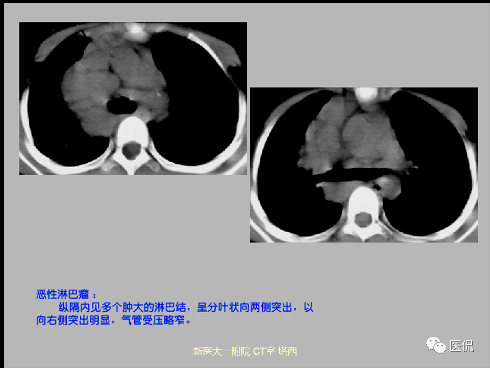 影像PPT - 【PPT】呼吸系统常见疾病影像诊断-124