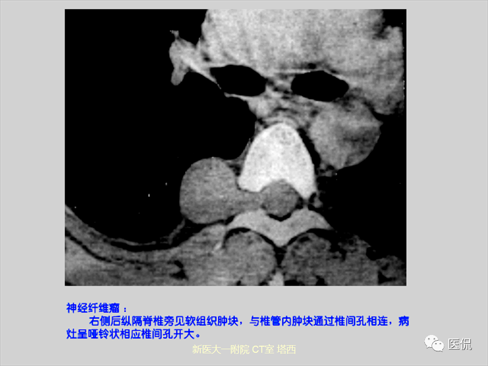 影像PPT - 【PPT】呼吸系统常见疾病影像诊断-127