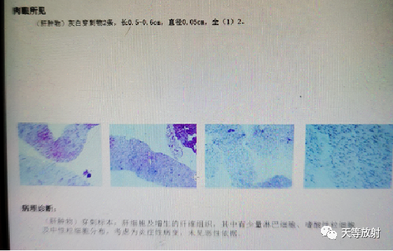 影像PPT - 【病例】肝脓肿1例CT影像-13 影像PPT - 【病例】肝脓肿1例CT影像-13