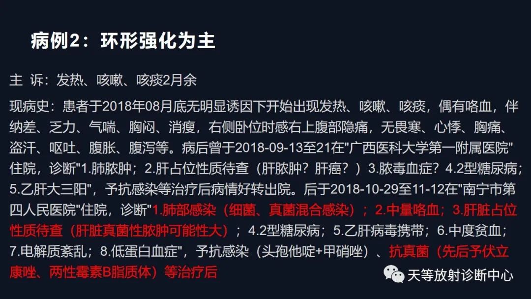 影像PPT - 【病例】肝脓肿1例CT影像-21 影像PPT - 【病例】肝脓肿1例CT影像-21