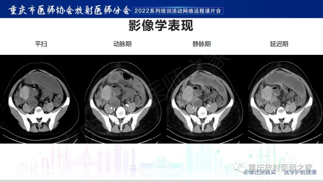 影像PPT - 【病例】腹腔纱布异物(纱布瘤)一例CT影像-3