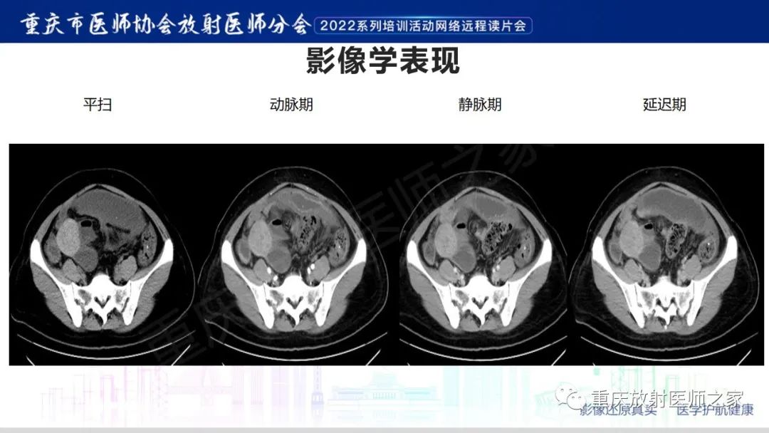影像PPT - 【病例】腹腔纱布异物(纱布瘤)一例CT影像-4
