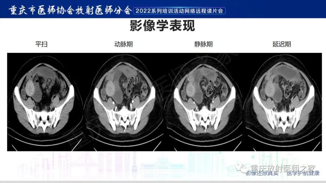 影像PPT - 【病例】腹腔纱布异物(纱布瘤)一例CT影像-5