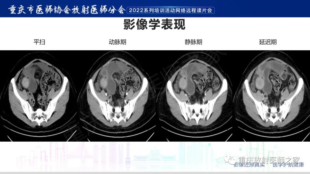 影像PPT - 【病例】腹腔纱布异物(纱布瘤)一例CT影像-6