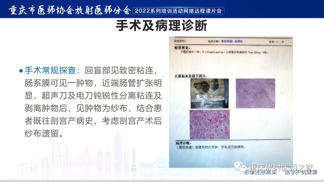 影像PPT - 【病例】腹腔纱布异物(纱布瘤)一例CT影像-9