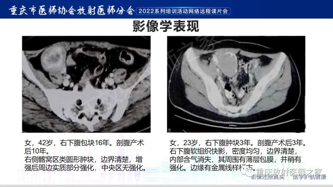 影像PPT - 【病例】腹腔纱布异物(纱布瘤)一例CT影像-13