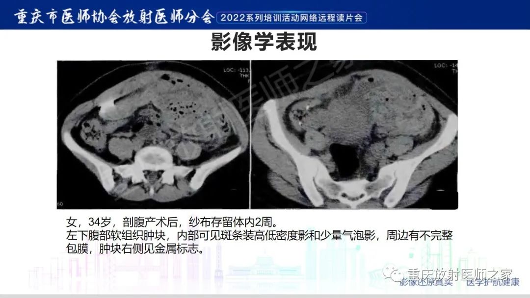影像PPT - 【病例】腹腔纱布异物(纱布瘤)一例CT影像-12