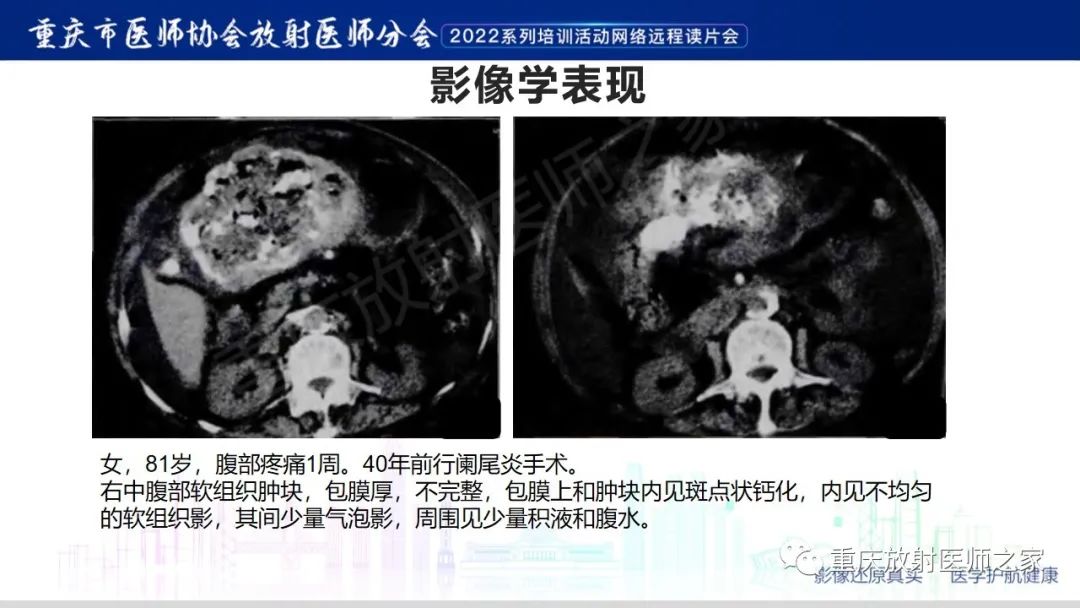 影像PPT - 【病例】腹腔纱布异物(纱布瘤)一例CT影像-14