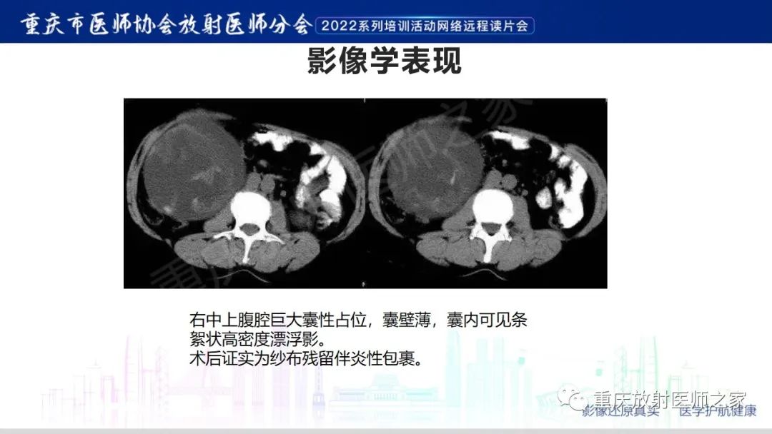 影像PPT - 【病例】腹腔纱布异物(纱布瘤)一例CT影像-15