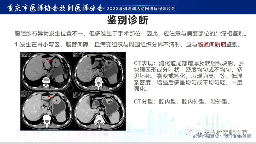 影像PPT - 【病例】腹腔纱布异物(纱布瘤)一例CT影像-16