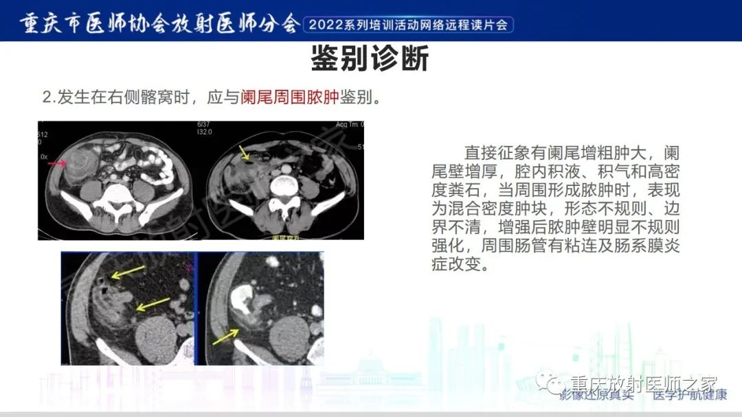 影像PPT - 【病例】腹腔纱布异物(纱布瘤)一例CT影像-17