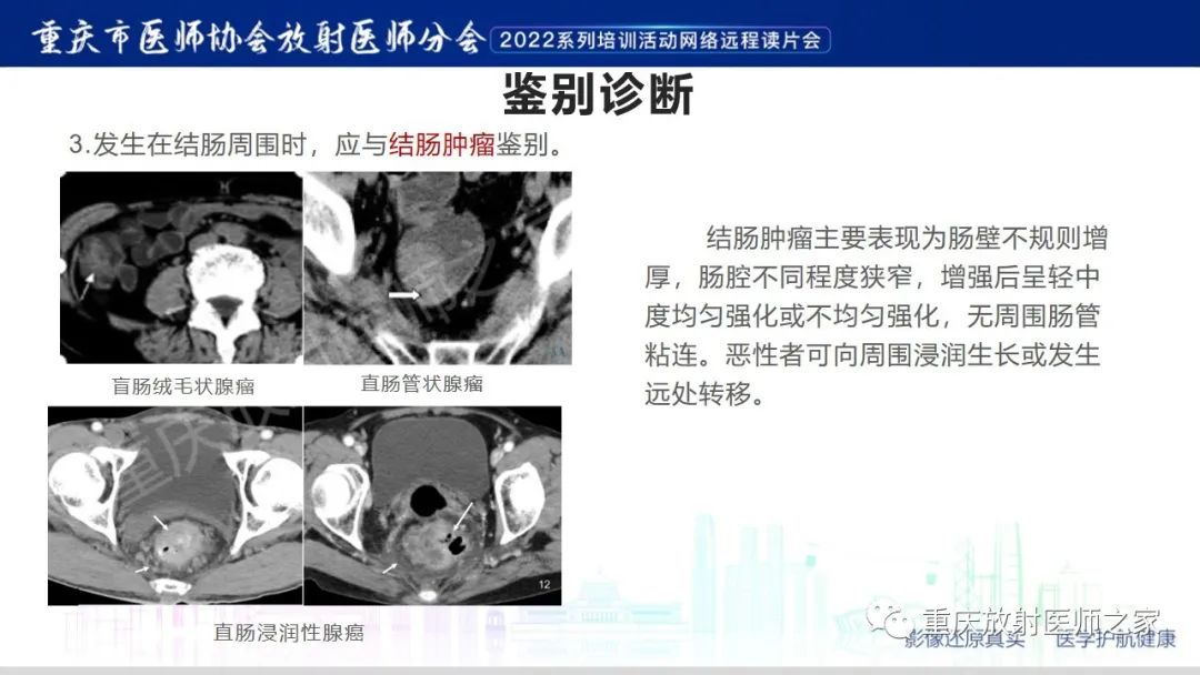 影像PPT - 【病例】腹腔纱布异物(纱布瘤)一例CT影像-18