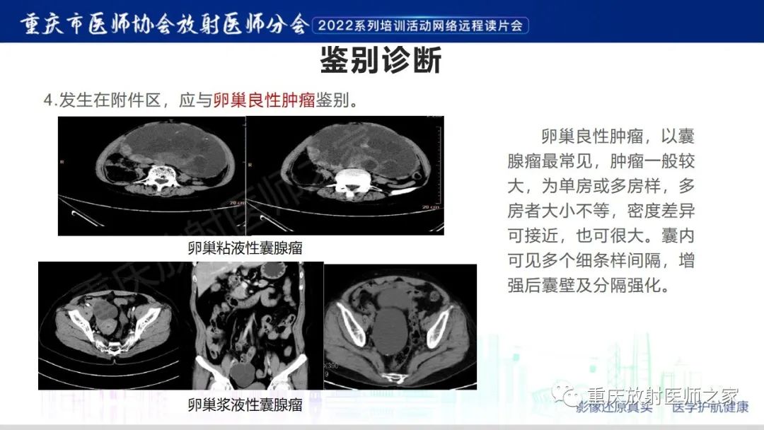 影像PPT - 【病例】腹腔纱布异物(纱布瘤)一例CT影像-19
