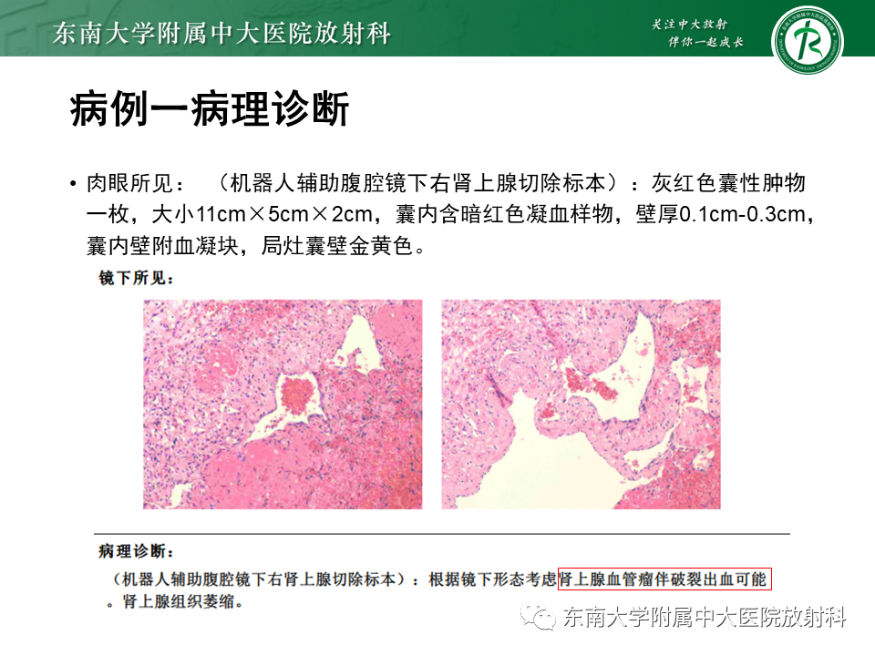 影像PPT - 【PPT】肾上腺占位病例随访-7