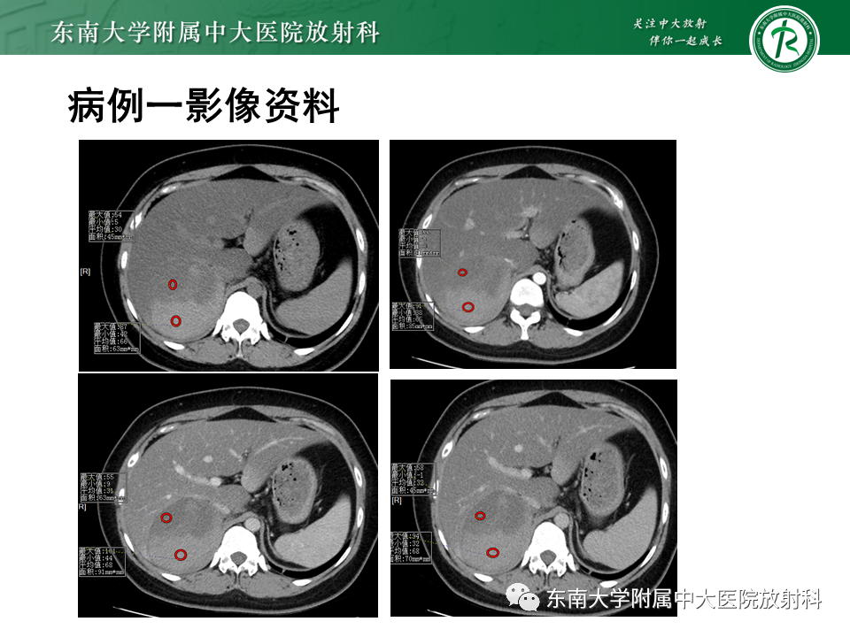 影像PPT - 【PPT】肾上腺占位病例随访-6
