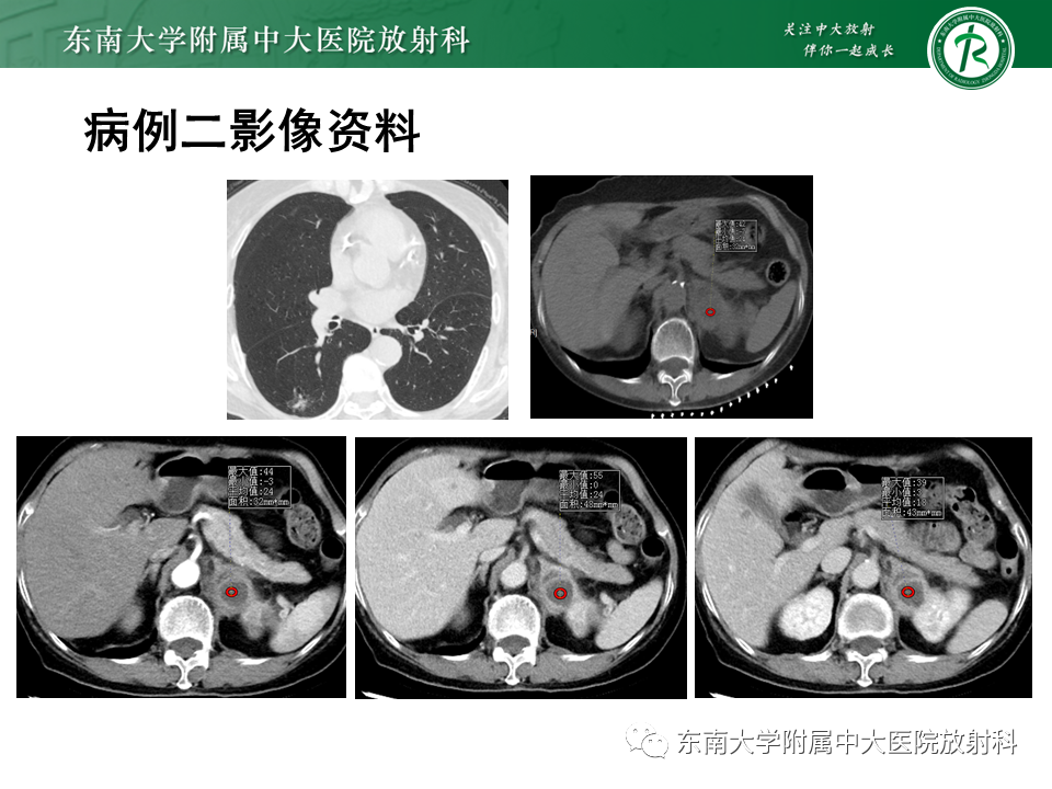 影像PPT - 【PPT】肾上腺占位病例随访-9