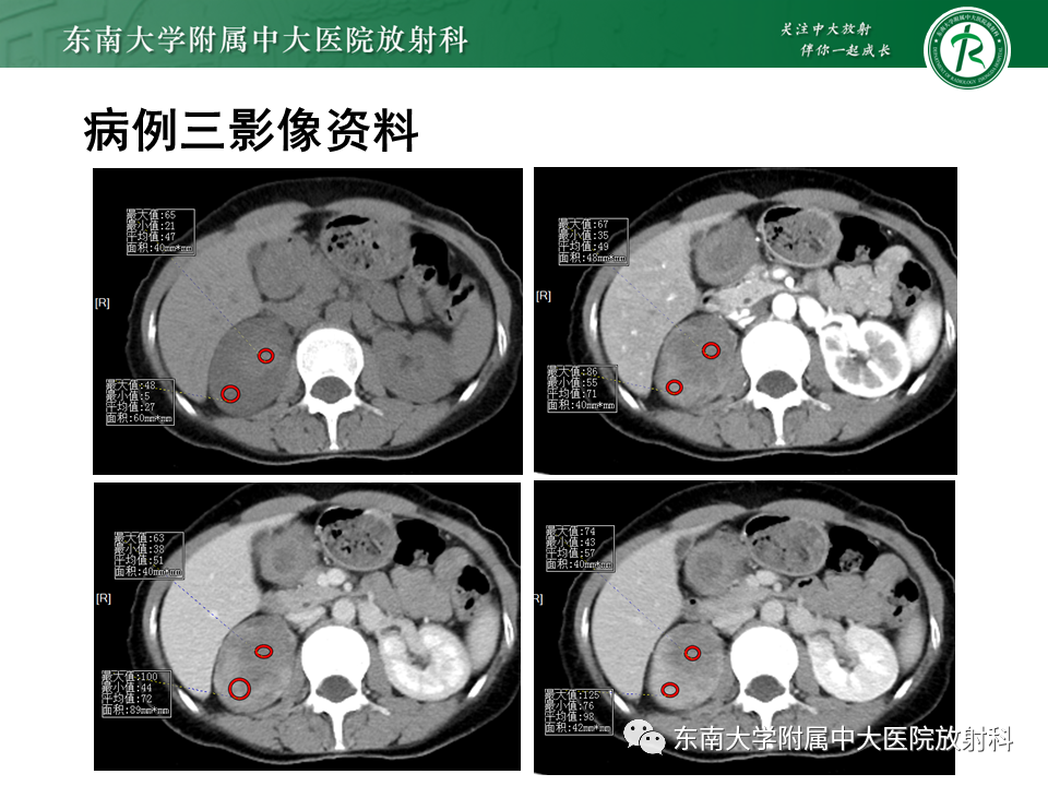 影像PPT - 【PPT】肾上腺占位病例随访-2