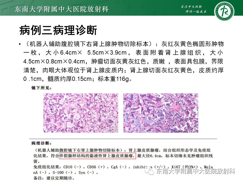 影像PPT - 【PPT】肾上腺占位病例随访-3