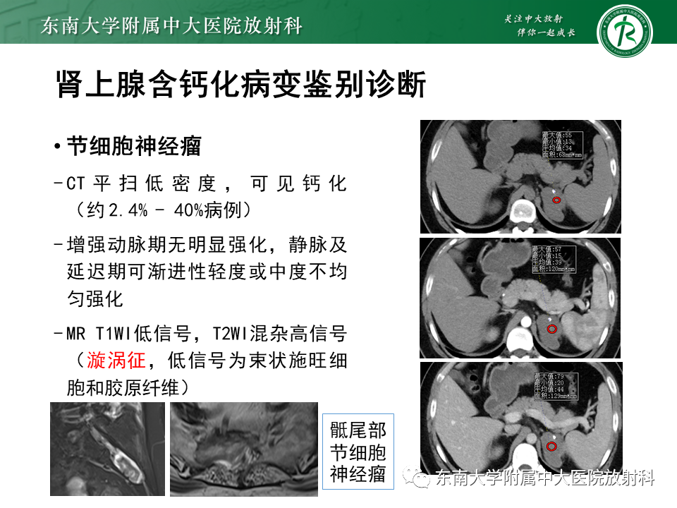 影像PPT - 【PPT】肾上腺占位病例随访-9